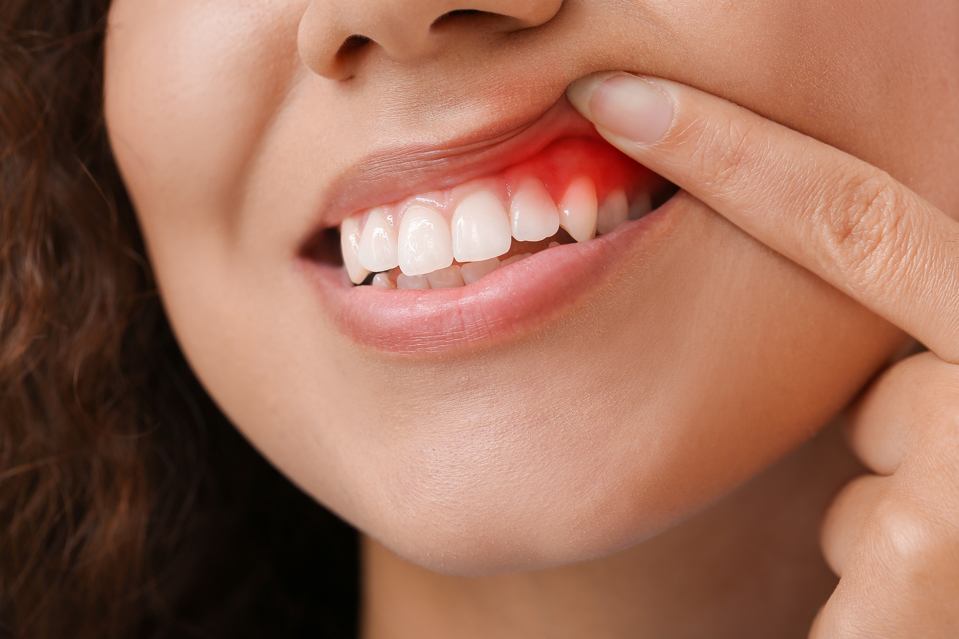 La gingivite et ses complications - Blogue santé dentaire - Centre dentaire BLL Patrice Lavoie